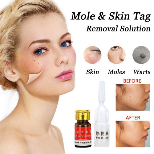 Removal Face Wart Tag Freckle Cream Removal Oil Mole Skin Tag Removal Solution Painless Mole Skin Dark Spot T