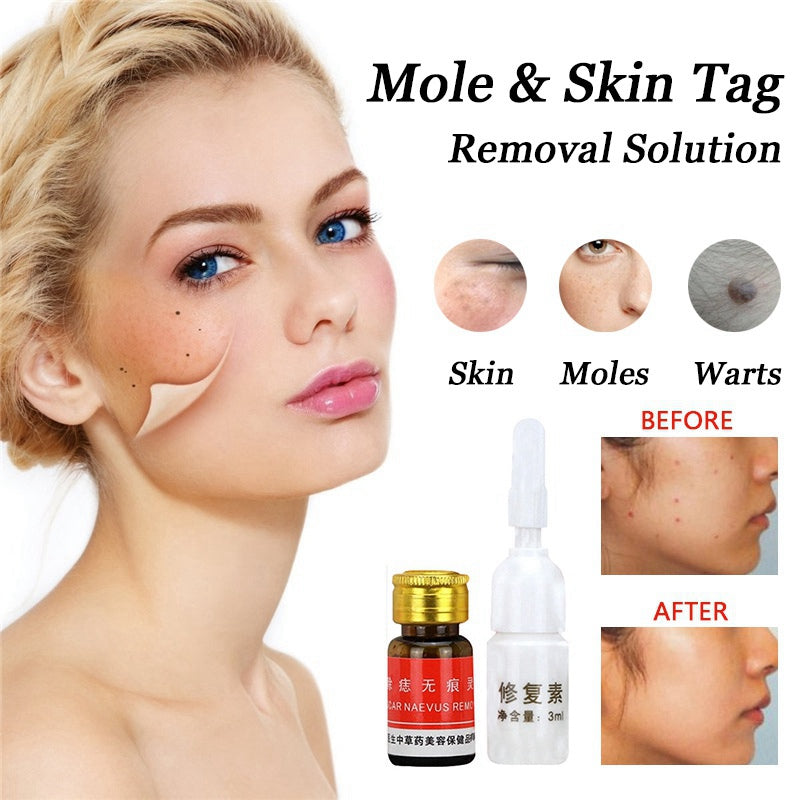 Removal Face Wart Tag Freckle Cream Removal Oil Mole Skin Tag Removal Solution Painless Mole Skin Dark Spot T